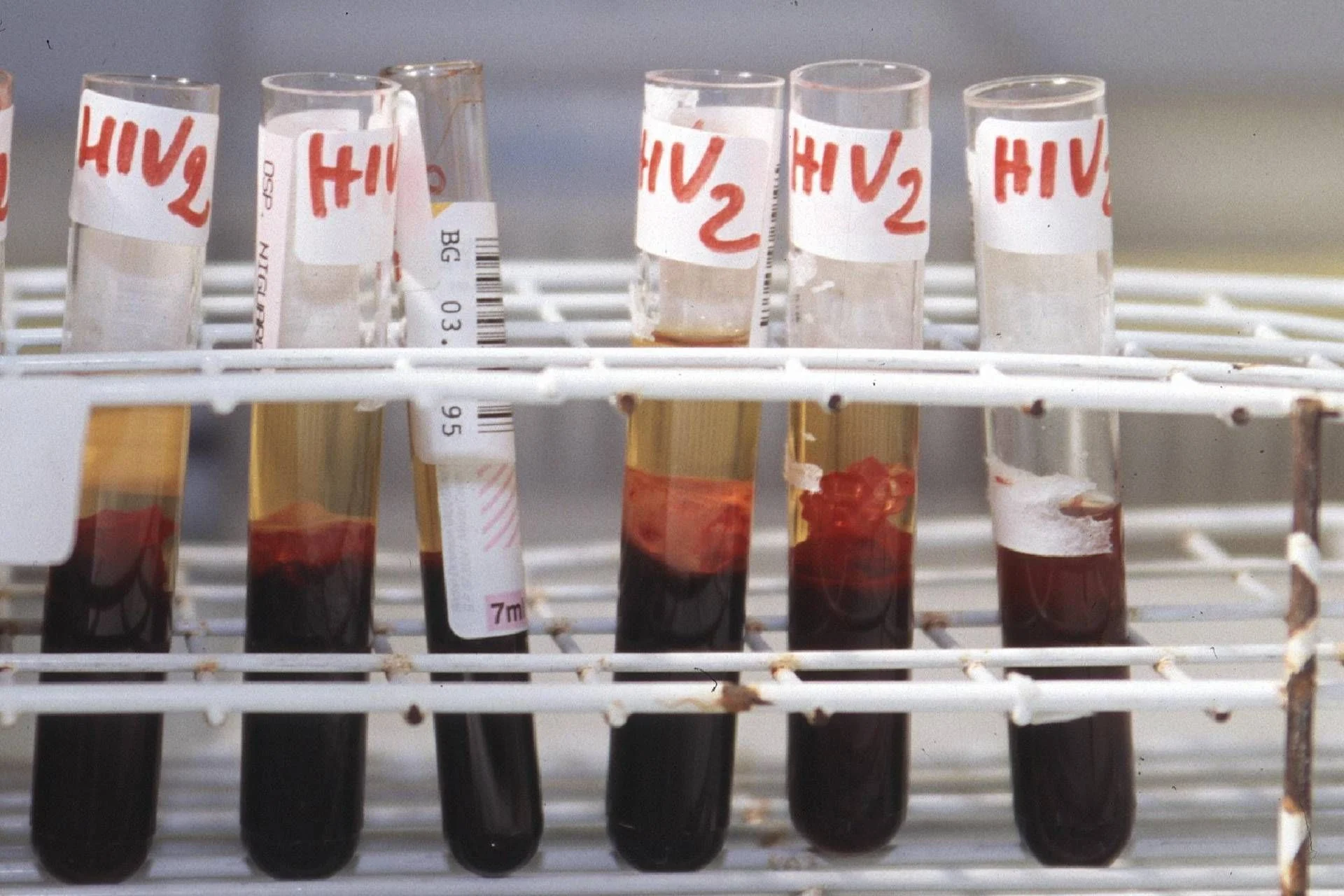 Terapias long acting melhoram adesão e freiam transmissão do HIV, diz especialista
