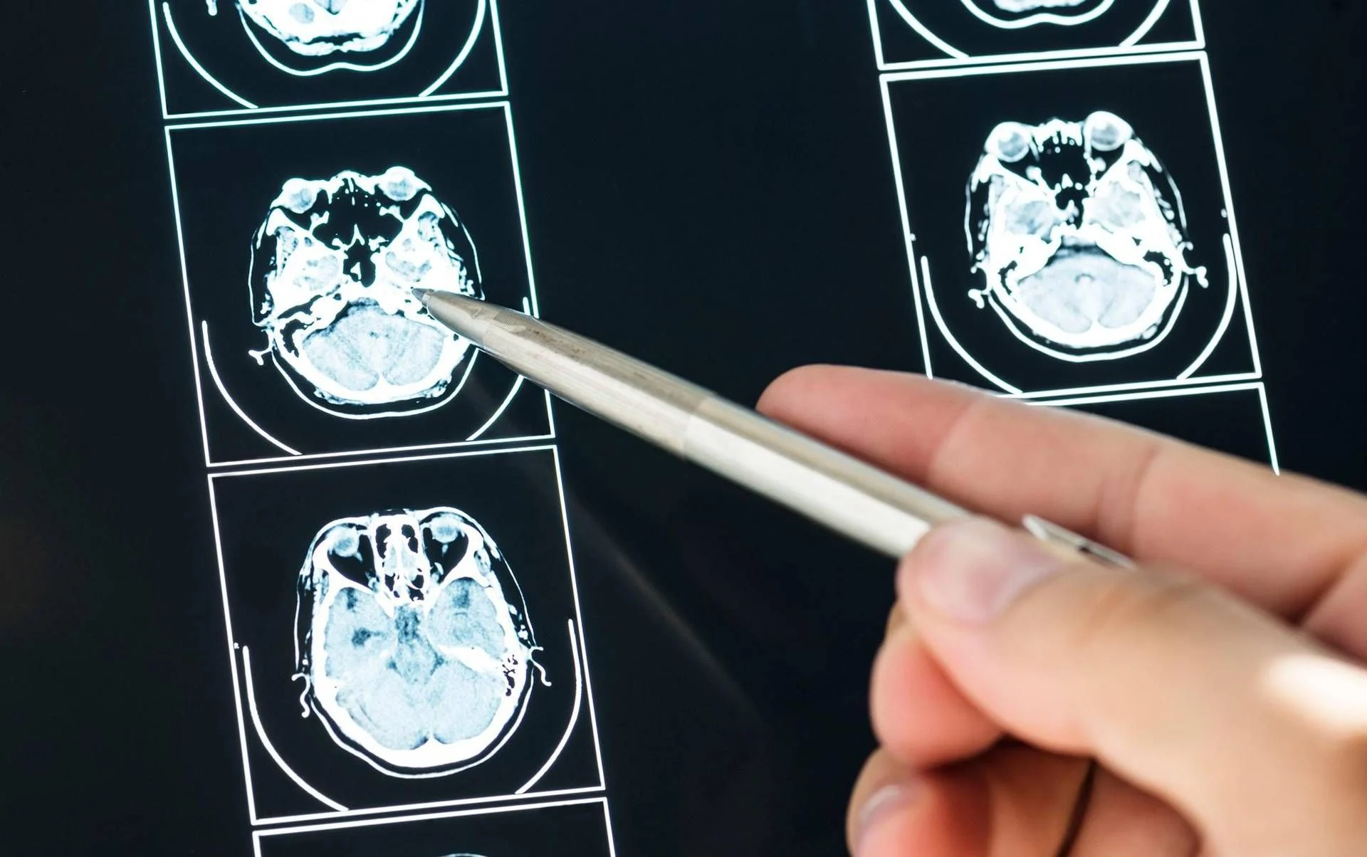 Long Covid altera o cérebro: plesso coroideo inchado e sinais típicos de Alzheimer, diz estudo