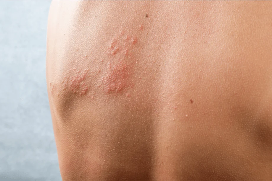 Vacinação e Herpes Zoster: metade dos maiores de 50 anos com doenças crônicas não discute o risco com o médico