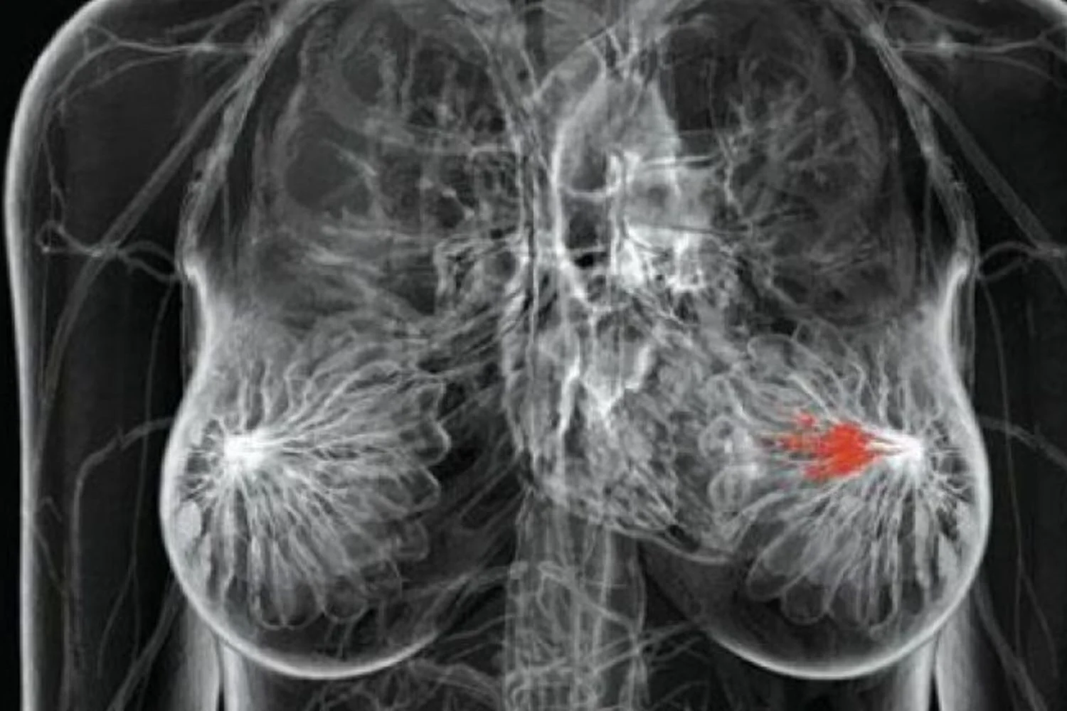 Dieta rica em gorduras acelera crescimento e invasividade de tumores de mama triplo-negativos, mostra estudo