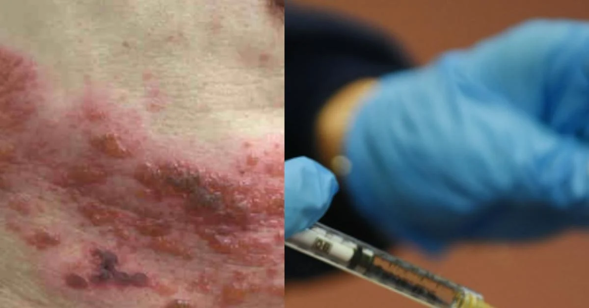 Vacina COVID a mRNA e herpes zoster: estudo detecta proteína Spike em lesões cutâneas e sugere reativação