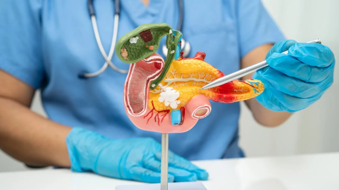 Tumor do pâncreas: mais de 13.585 novas diagnósticos em 2024 e a esperança do diagnóstico precoce
