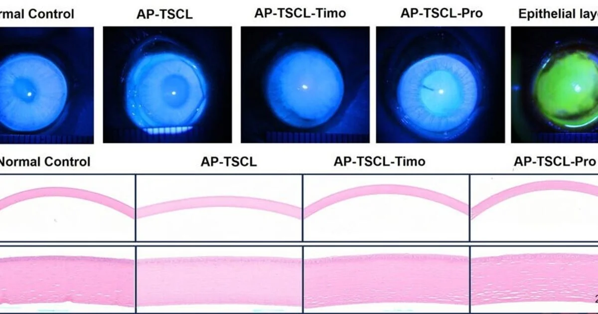 Lente a contato inteligente monitora e trata o glaucoma sem baterias