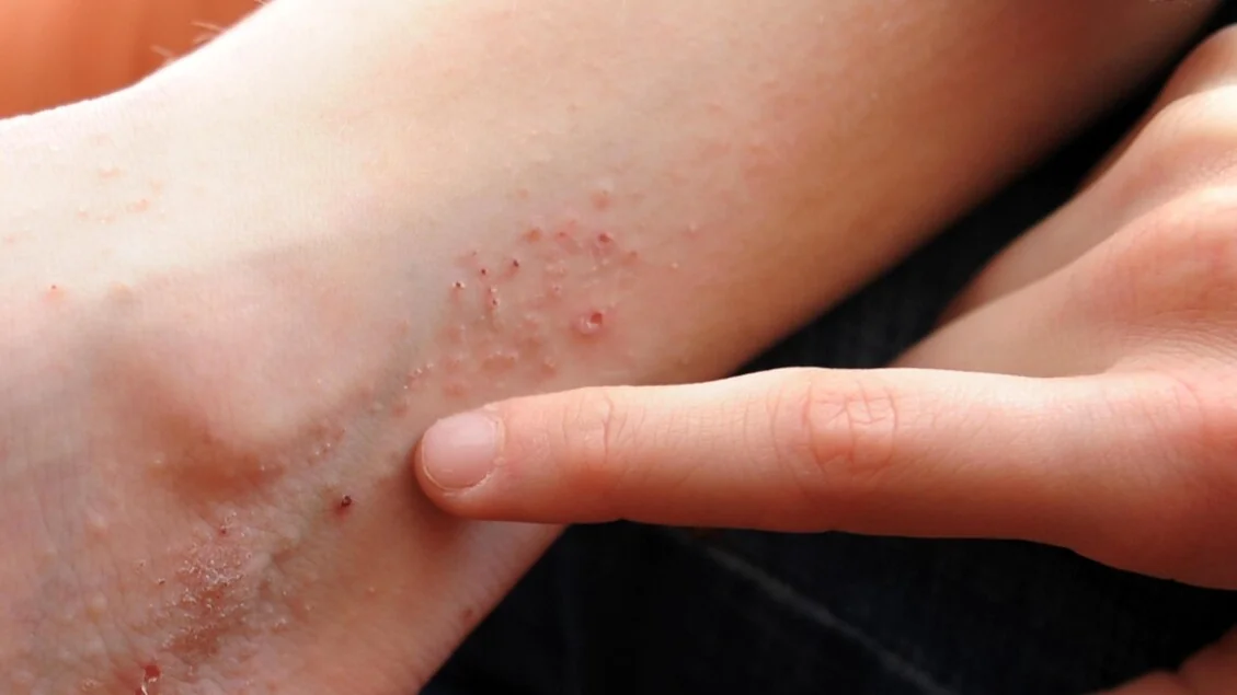 Prurido crônico: sintoma subestimado que exige prioridade clínica, dizem dermatologistas