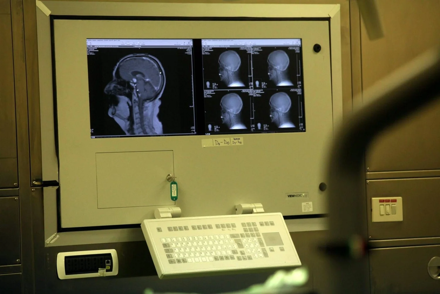 Sonhos agitados podem indicar Parkinson? Especialistas explicam quando investigar com polissonografia