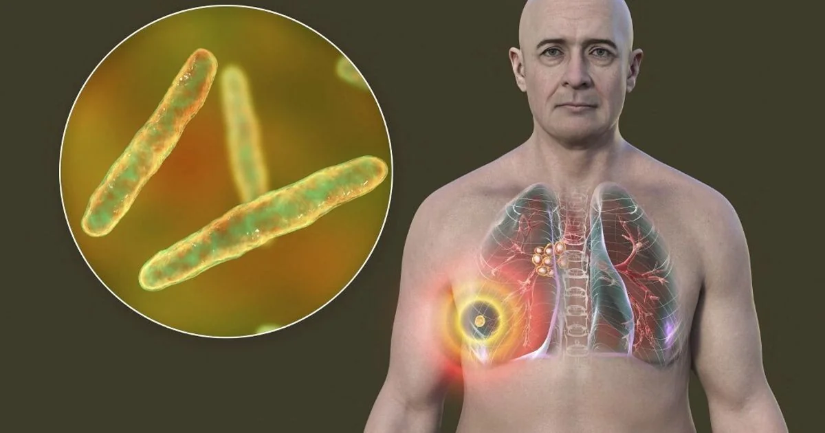 Top TB: novo teste molecular ultrasensível revela casos ocultos de tuberculose