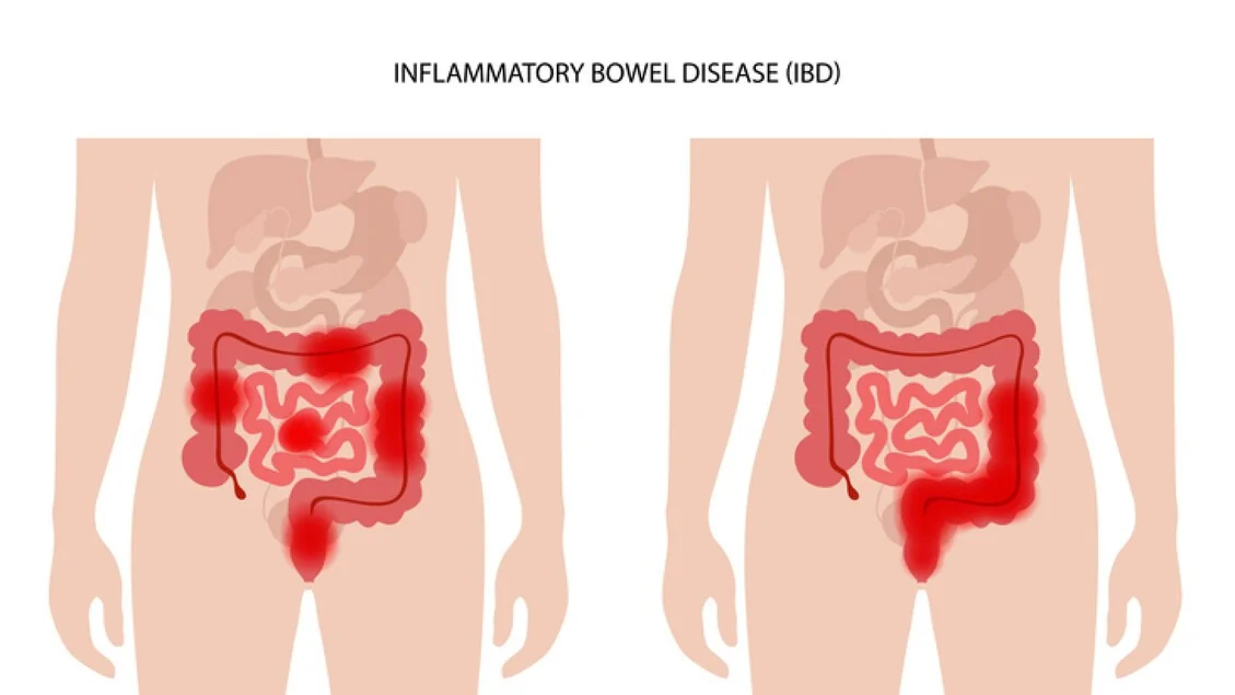 Doença de Crohn e colite ulcerativa: 20% dos pacientes italianos em risco de desnutrição