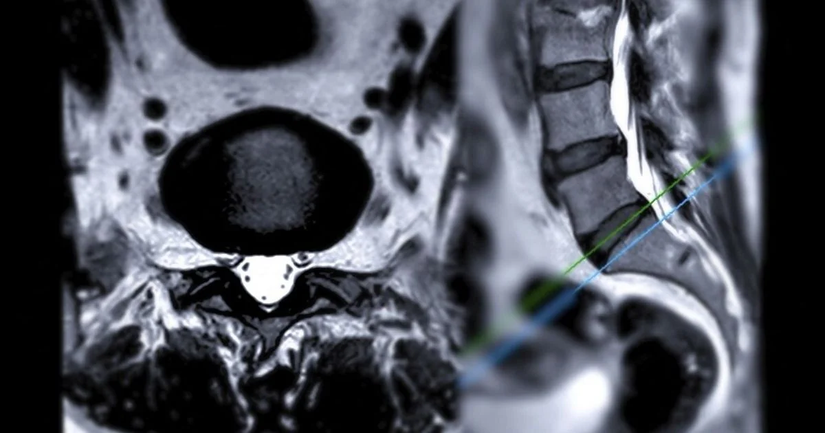 Anticorpo experimental NG101 mostra capacidade de regenerar a medula espinhal após trauma