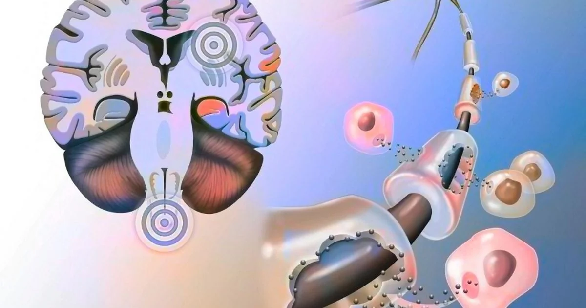 Estudo em The Lancet mostra que o ocrelizumab reduz progressão da esclerose múltipla primariamente progressiva