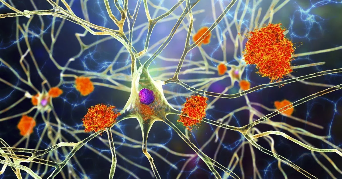 Novo modelo revela como Alzheimer pode ser desencadeado pela combinação de amiloide e vasos cerebrais