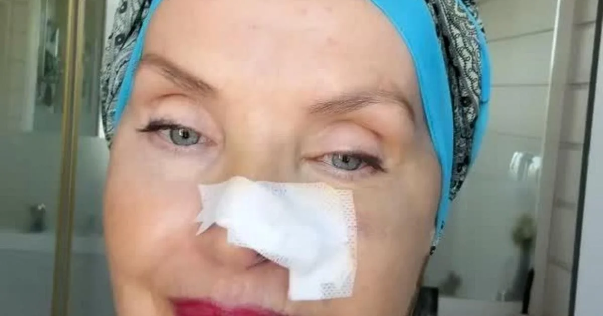 Nadia Mayer revela cirurgia por basalioma no nariz: “Pensava ser um furúnculo”