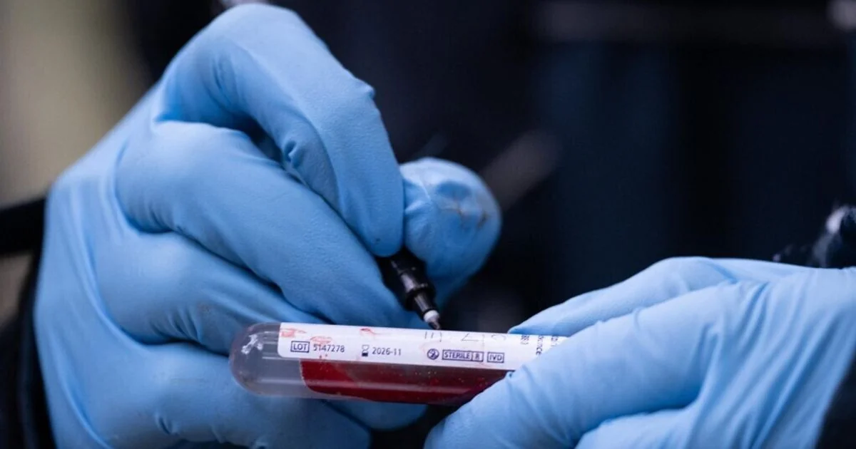 Teste de sangue com ddPCR identifica doença residual oculta no câncer de pâncreas
