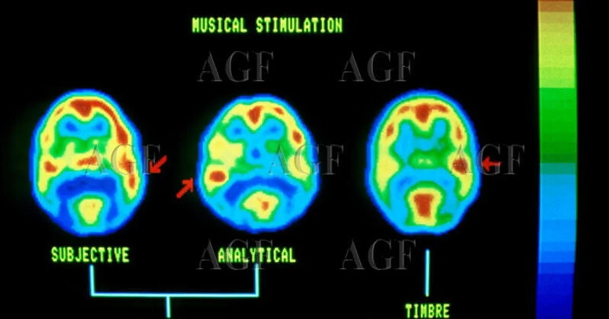 Atividade cerebral permite reconstruir as melodias que imaginamos, diz estudo