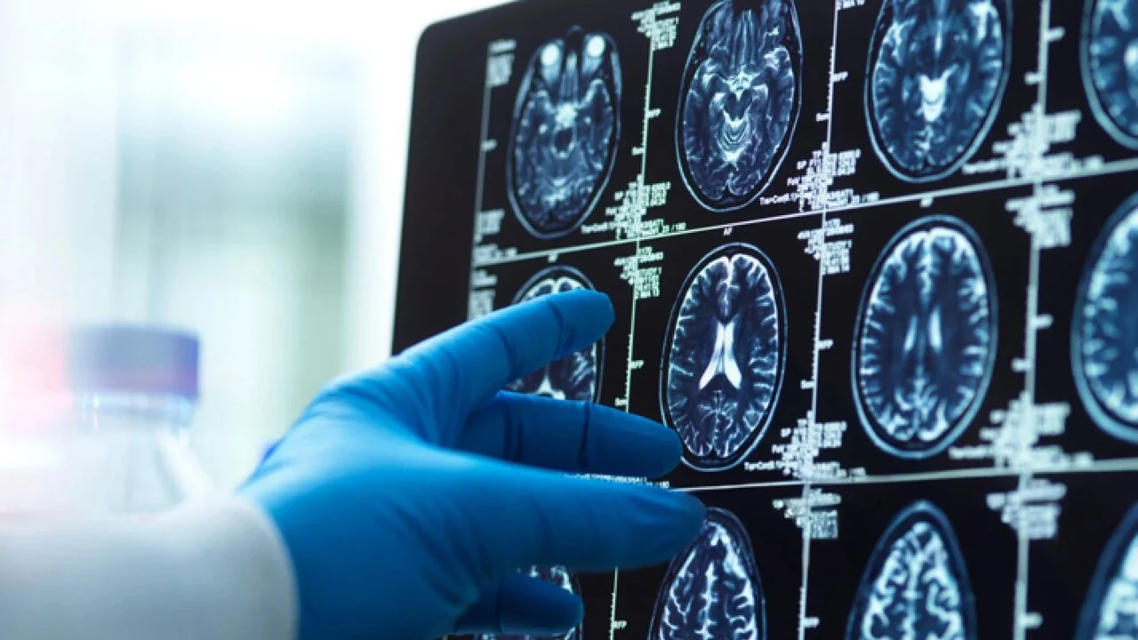 Revolução em Londres: primeira remoção de tumor no cérebro assistida por inteligência artificial