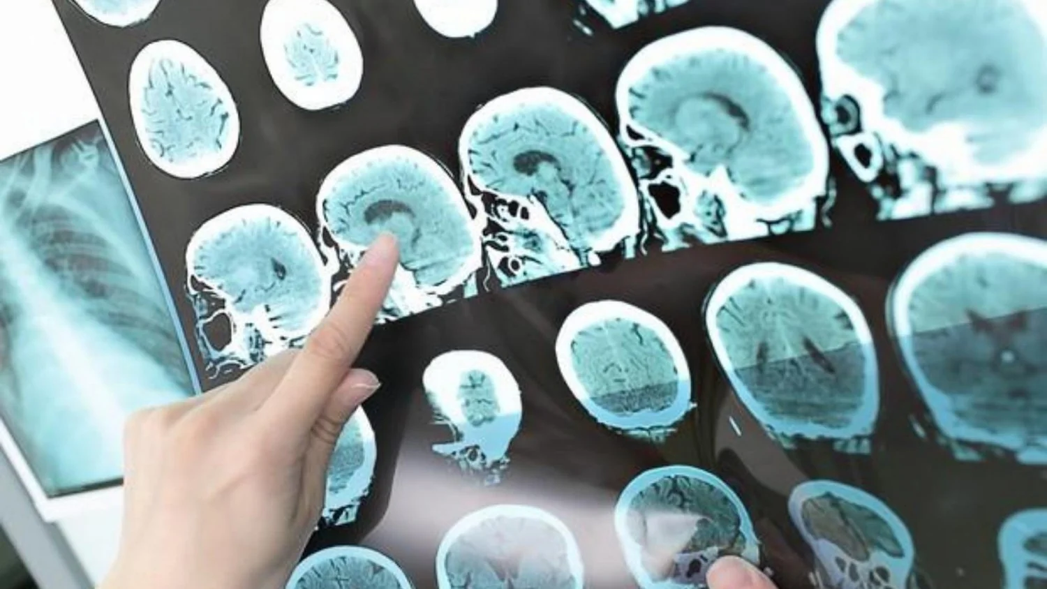 Alzheimer na Itália: 600 mil afetados, desafios e novidades entre diagnóstico e terapias