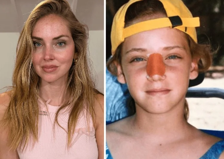 Chiara Ferragni revela por que o nariz está torto: o acidente em Maui que marcou o rosto