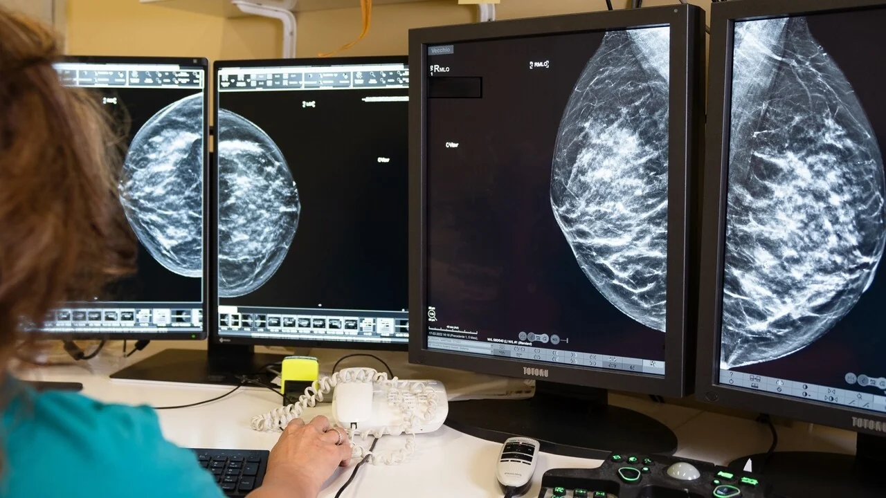Com diagnóstico precoce, sobrevida a 10 anos para câncer de mama ultrapassa 90% na Itália
