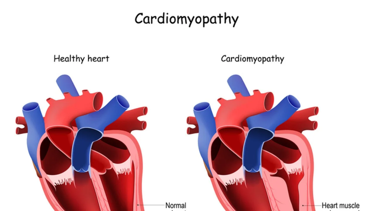Dados de cinco anos reforçam eficácia e segurança da Mavacamten na cardiomiopatia hipertrófica obstrutiva