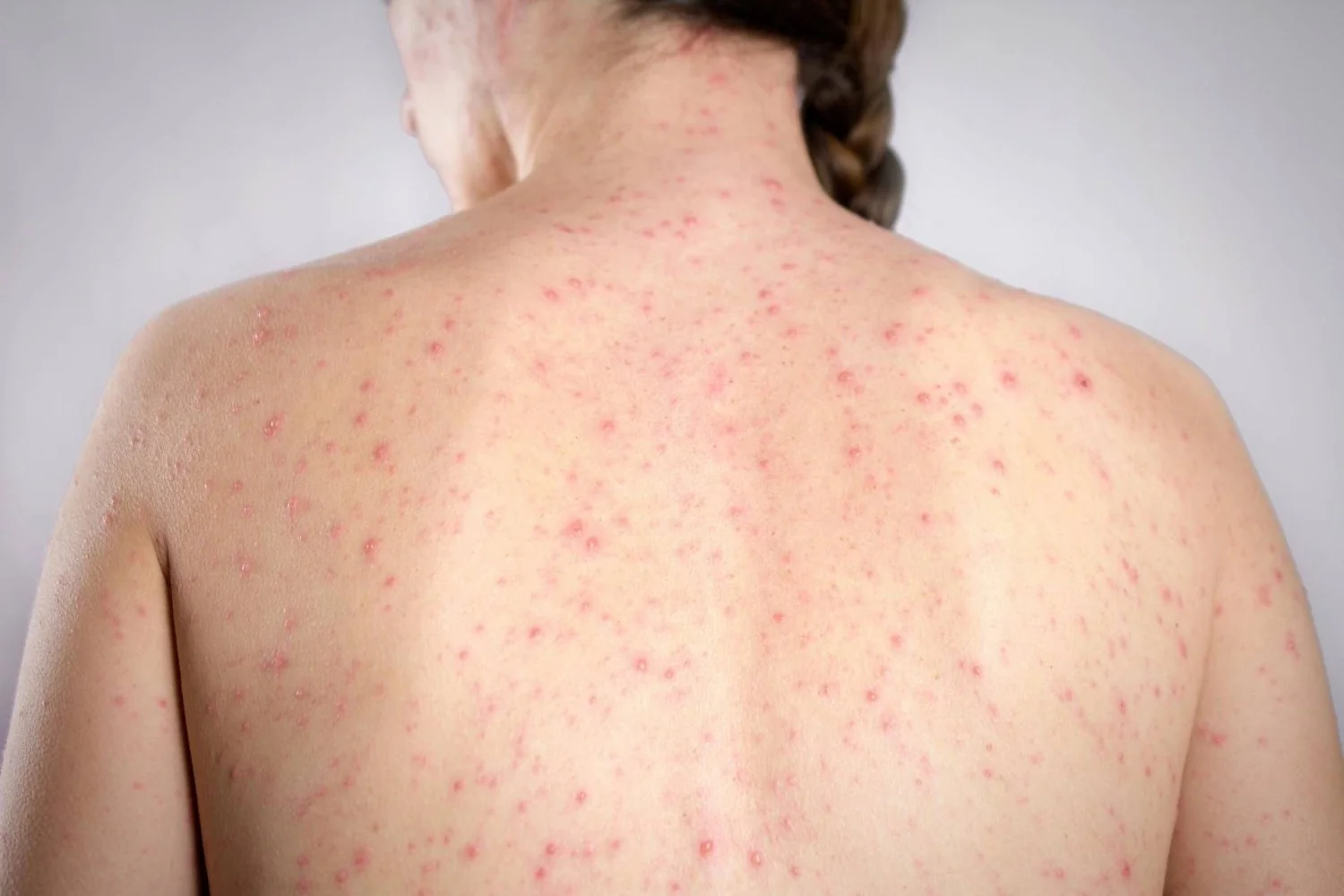 Morbillo em 2026: EUA enfrentam surto histórico; Itália lidera casos na Europa, aponta relatório do ECDC