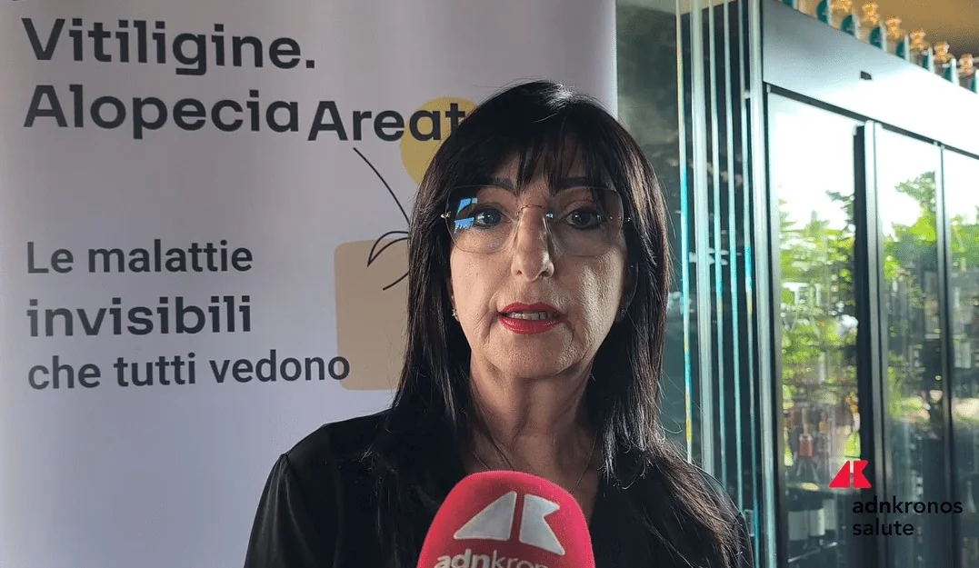 Aipaf: com novas terapias, SSN deve reconhecer a alopecia areata e apoiar pacientes