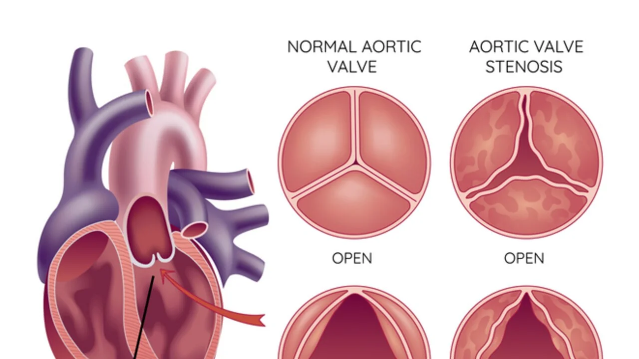 Tavi por cateter: substituir a válvula sem abrir o peito amplia acesso e desafoga filas