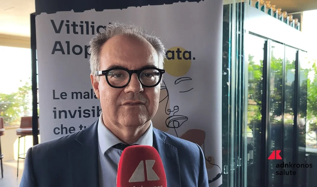 Upadacitinib mostra eficácia contra vitiligo e alopecia areata, diz Sidemast