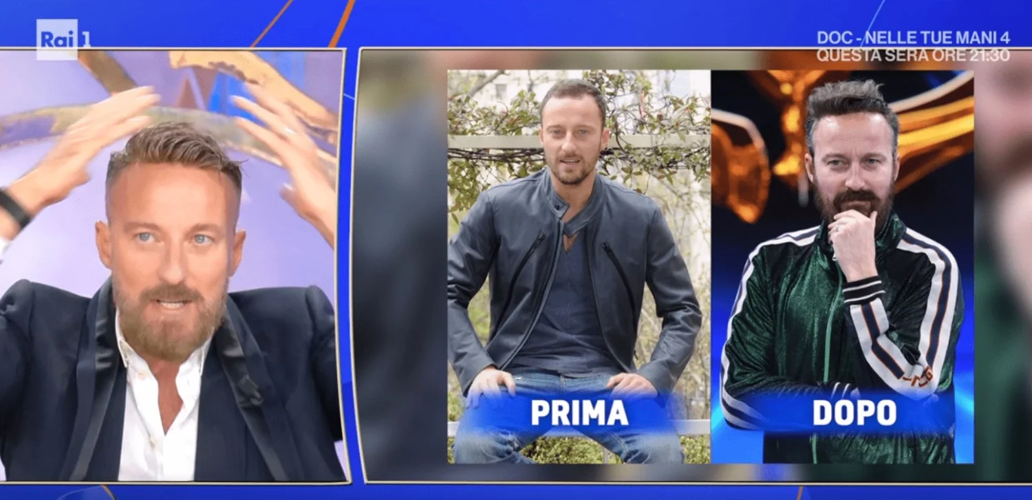 Francesco Facchinetti e a vitória sobre a calvície: a solução inesperada da patch cutânea