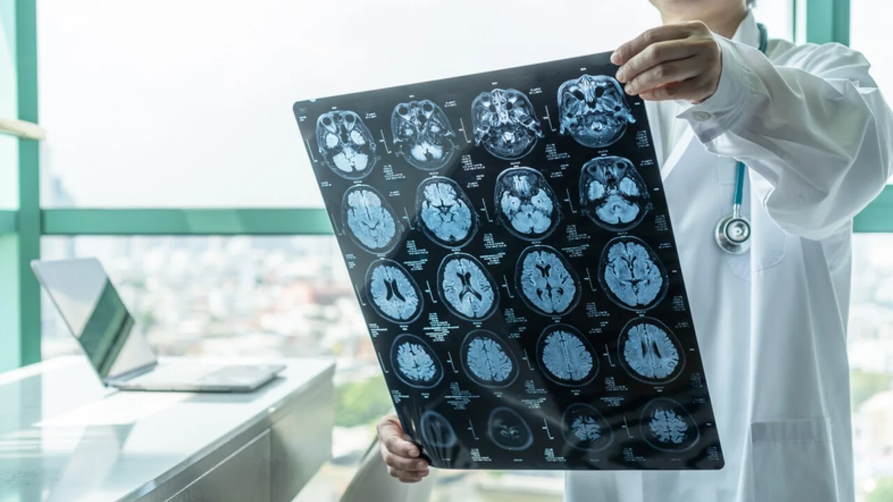 Na Itália, 100 mil casos de ictus por ano: como reconhecer e agir rápido