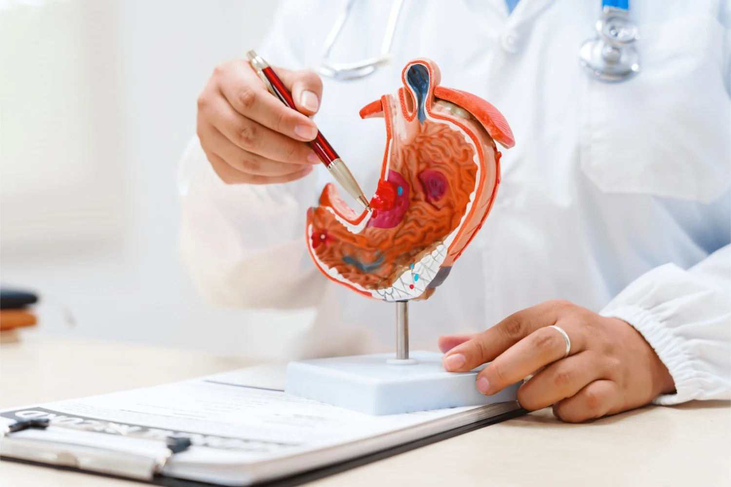 Nova terapia com Sonesitatug Vedotin reduz em 42% o risco de morte no câncer gástrico avançado