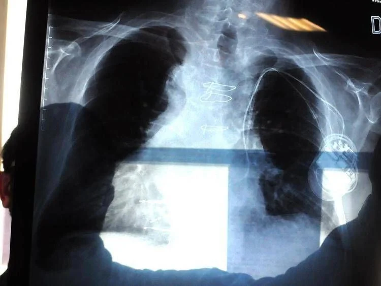 Combinação de tarlatamab e durvalumab reduz 58% o risco de morte em câncer pulmonar pequeno‑células avançado