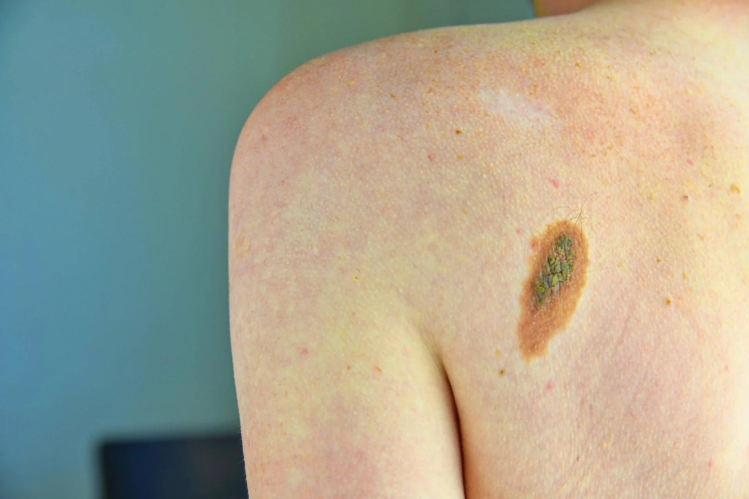 Vacina personalizada com mRNA reduz risco de recidiva no melanoma resecado, diz estudo de fase 3