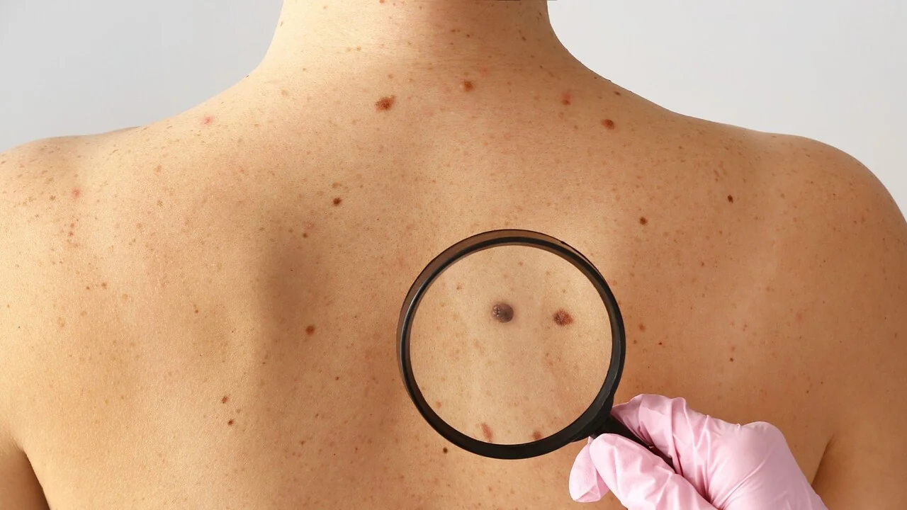 Vacina personalizada com mRNA reduz em 42% risco de recidiva do melanoma
