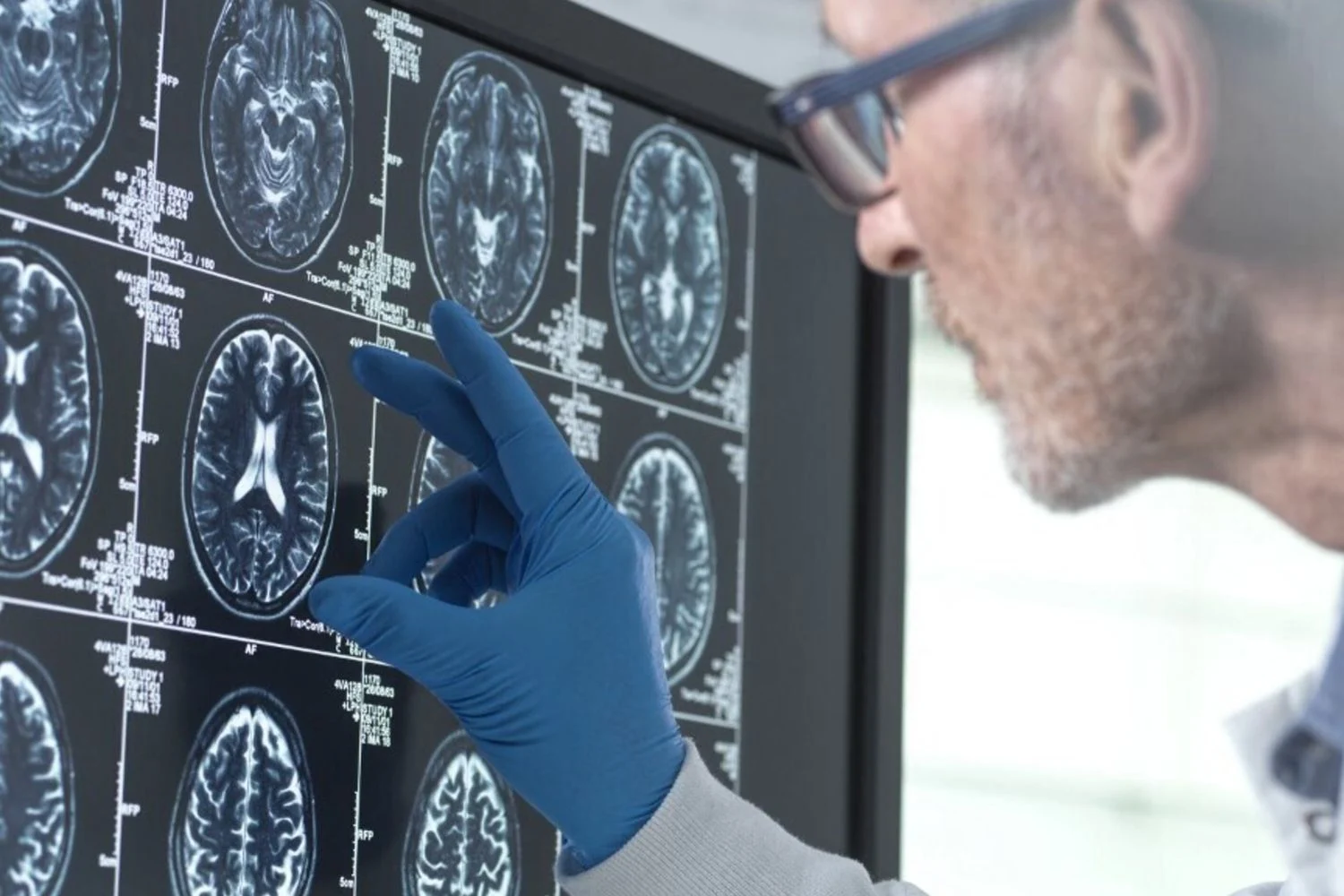 CRISPR revela 331 genes essenciais para o desenvolvimento cerebral e identifica PEDS1 ligado a raro distúrbio neuroevolutivo